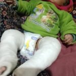 RBSK योजना बनी नवजात के लिए वरदान, ‘क्लब फुट’ से ग्रसित शिशु का सफल उपचार